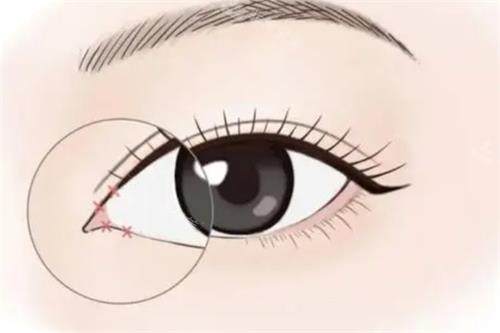 开眼角手术动画图示
