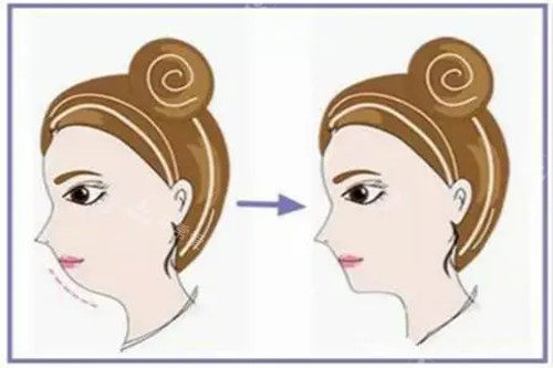 假体垫下巴侧面示意图 假体垫下巴侧面示意图