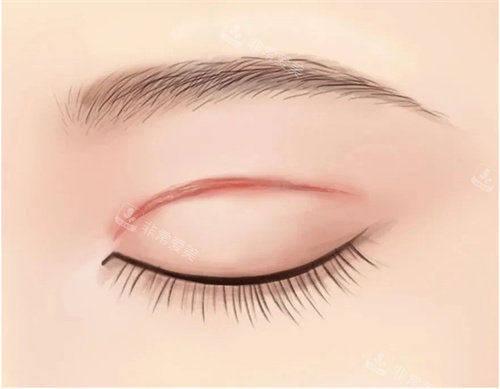 双眼皮肉条疤痕图 双眼皮肉条疤痕图