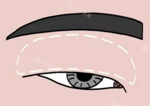 肿眼泡做双眼皮对比示意图