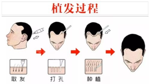 植发过程示意图 植发过程示意图