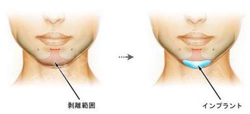 注射垫下巴示意图 注射垫下巴示意图