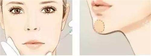 注射垫下巴的部位 注射垫下巴的部位