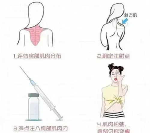 瘦肩注射过程动画图 瘦肩注射过程动画图