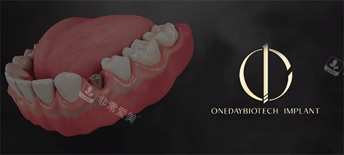 韩一种植牙照片