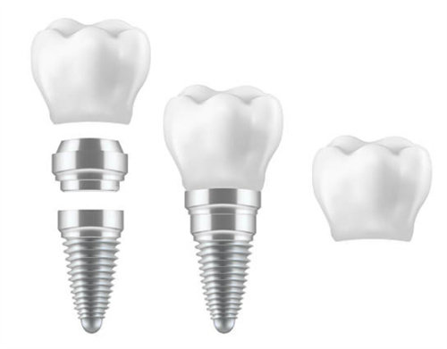 种植牙的各个部分