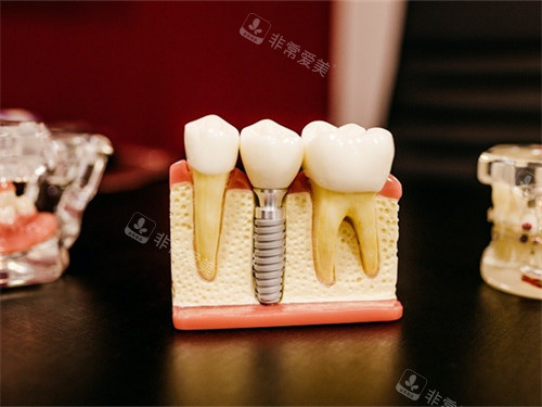 种植牙的牙齿模型展示图