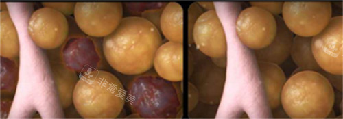 美国既塑3D溶脂前后脂肪细胞变化