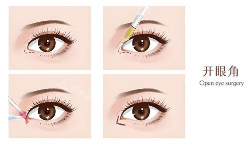 开内眼角演示动画图 开内眼角演示动画图