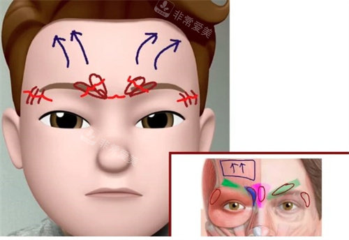 内窥镜提升额头 内窥镜提升额头