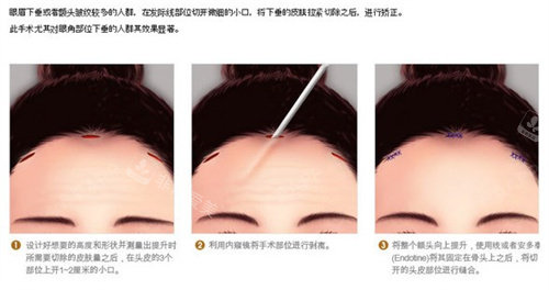 内窥镜提升额头适合人群 内窥镜提升额头适合人群