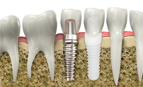 安卓健种植牙修复图