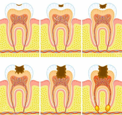 需要根管治疗的牙齿