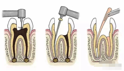 根管治疗过程展示图