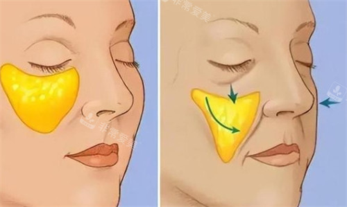 面部苹果肌提升前后对比 面部苹果肌提升前后对比