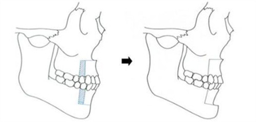 双鄂手术过程演示动画图 双鄂手术过程演示动画图