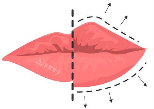 唇部整形示意图 唇部整形示意图