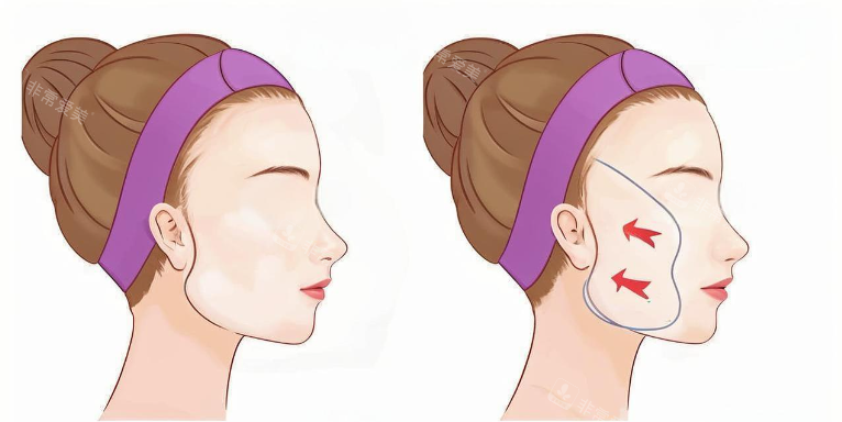 北京王志军做SMAS拉皮手术实拍！来看医生技术亮点|术后成效|真实反馈|收费价格等