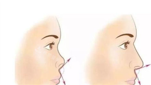 隆鼻前后对比示图