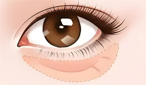 查看2026高富雷医生去眼袋手术价格表：从基础微创到高难度修复，1800-32000元起适配不同需求！