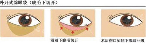 外切法祛眼袋手术步骤