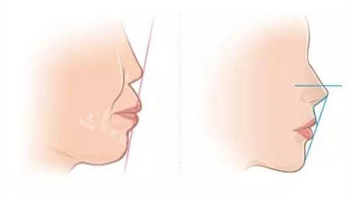 鼻基底矫正前后对比示意图