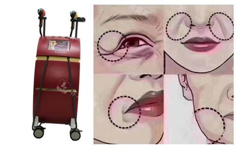 被“赴韩热拉提做完垮脸”吓到犹豫，体验后才知多虑，皮肤紧致显年轻，无广纯干货分享