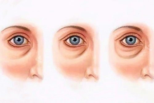 眼袋加深卡通图