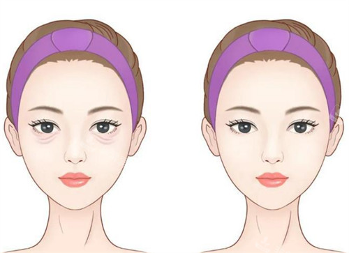 年轻祛眼袋前后对比 年轻祛眼袋前后对比