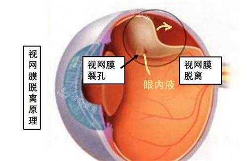 视网膜脱落原理