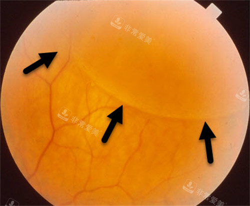 视网膜劈裂图示
