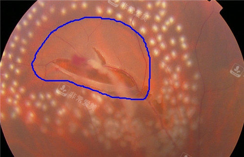 视网膜脱落细节图片