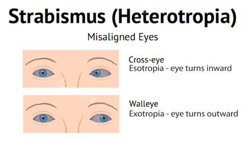 正常眼睛和斜视眼睛对比