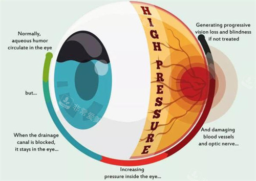 青光眼眼压和房水都有问题