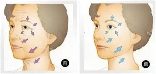 面部抗衰对比图 面部抗衰对比图