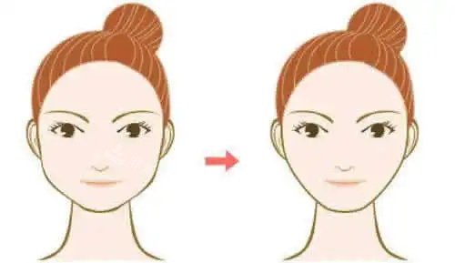 下颌角整形对比图 下颌角整形对比图