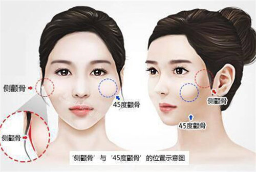 韩国做颧骨缩小手术真实经历分享，术前沟通充分术后护理到位/脸型更柔和/改善过程顺利很满意！