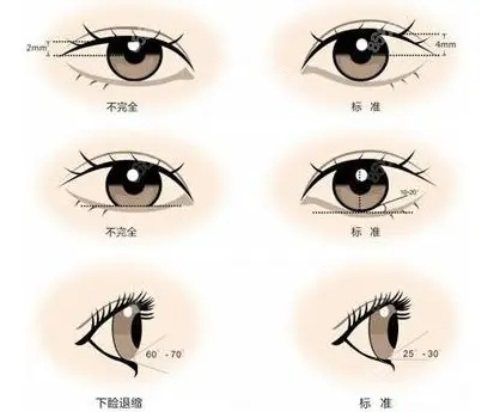 双眼皮对比图 双眼皮对比图