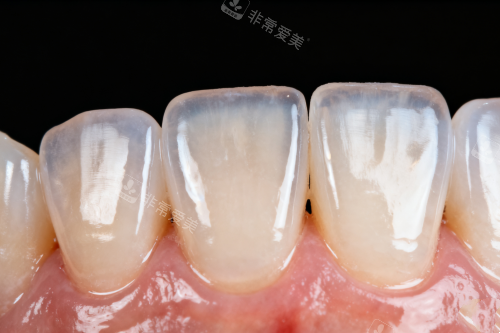 牙齿发黄卡通展示图