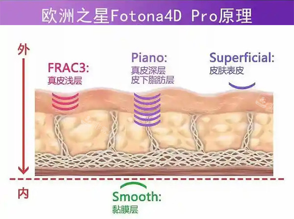 欧洲之星fotona4dpro原理示意图