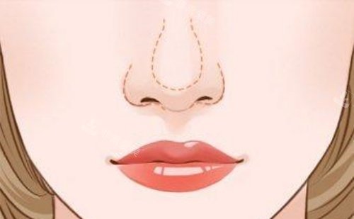 鼻小柱延长漫画图