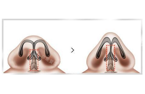 鼻小柱延长手术改善剖面图