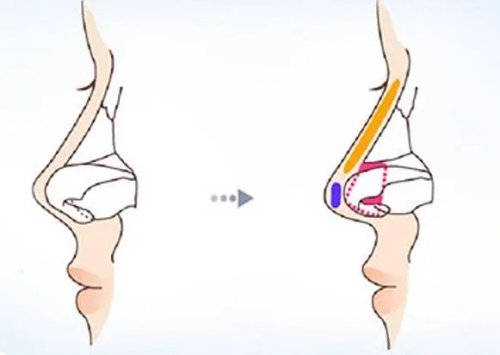 鼻小柱延长结构示意图