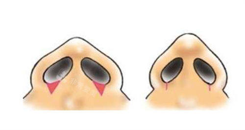 鼻小柱矫正前后对比示意图