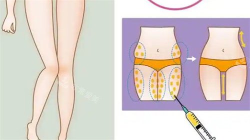 大腿吸脂手术