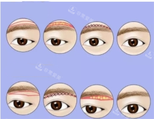 提眉手术完整流程图