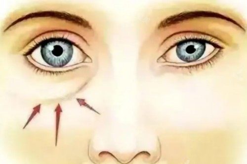 泪沟卡通展示图