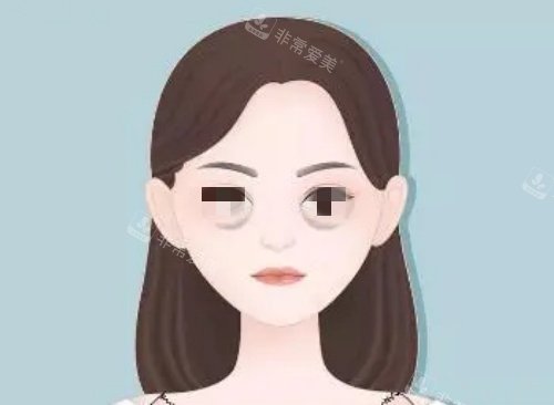 泪沟漫画示意图