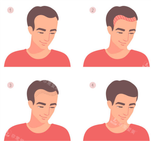 北京植发医院哪家好?雍禾/碧莲盛/首瑞女性植发都是连锁口碑也确保的!