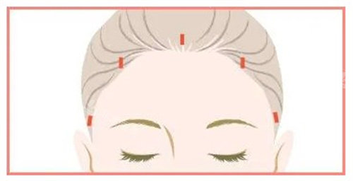 揭秘mcr复合提升术：紧致肌肤、重拾青春，你不可不知的医美新选择！